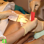 МЕТОДИКА НАЛОЖЕНИЯ ПОВЯЗКИ С ПРИМЕНЕНИЕМ СУПРАСОРБ CNP image