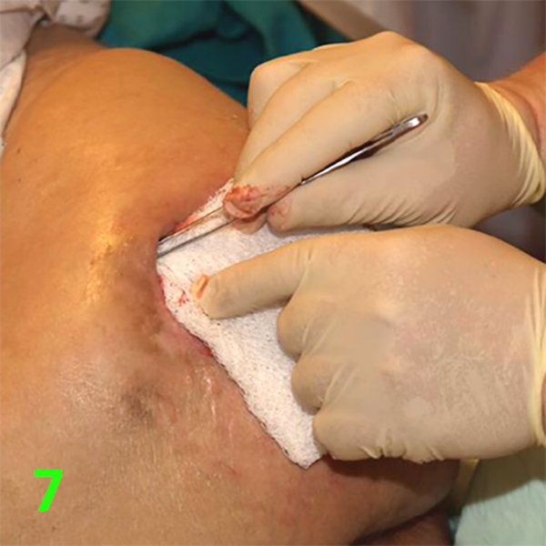 МЕТОДИКА НАЛОЖЕНИЯ ПОВЯЗКИ С ПРИМЕНЕНИЕМ СУПРАСОРБ CNP image