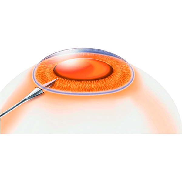 ВИТРЕОРЕТИНАЛЬНЫЙ СКАЛЬПЕЛЬ image