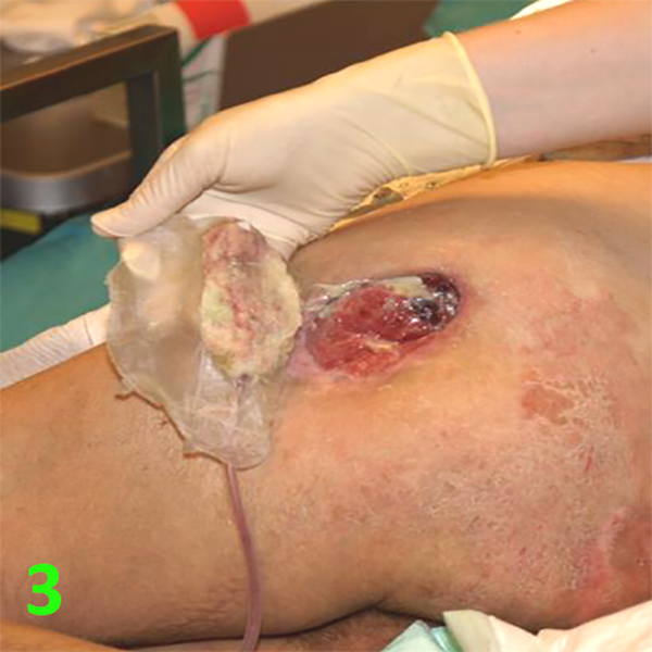 МЕТОДИКА НАЛОЖЕНИЯ ПОВЯЗКИ С ПРИМЕНЕНИЕМ СУПРАСОРБ CNP image