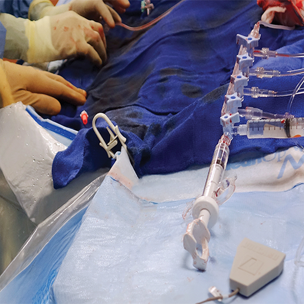 ПРОВОДНИКИ С ДАТЧИКОМ ДАВЛЕНИЯ ДЛЯ ИЗМЕРЕНИЯ ФРАКЦИОННОГО РЕЗЕРВА VERRATA PLUS image