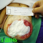 КЛИНИЧЕСКИЙ СЛУЧАЙ №1. ЭКЗАРТИКУЛЯЦИЯ С РЕВИЗИЕЙ КУЛЬТИ image