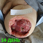 КЛИНИЧЕСКИЙ СЛУЧАЙ №1. ЭКЗАРТИКУЛЯЦИЯ С РЕВИЗИЕЙ КУЛЬТИ image