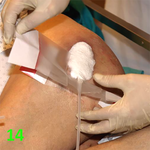 МЕТОДИКА НАЛОЖЕНИЯ ПОВЯЗКИ С ПРИМЕНЕНИЕМ СУПРАСОРБ CNP image