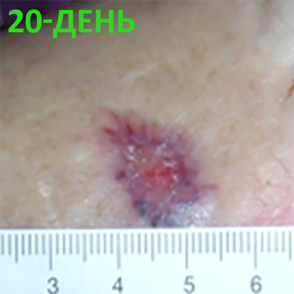 КЛИНИЧЕСКИЙ СЛУЧАЙ №5. ДИАБЕТИЧЕСКАЯ СТОПА image