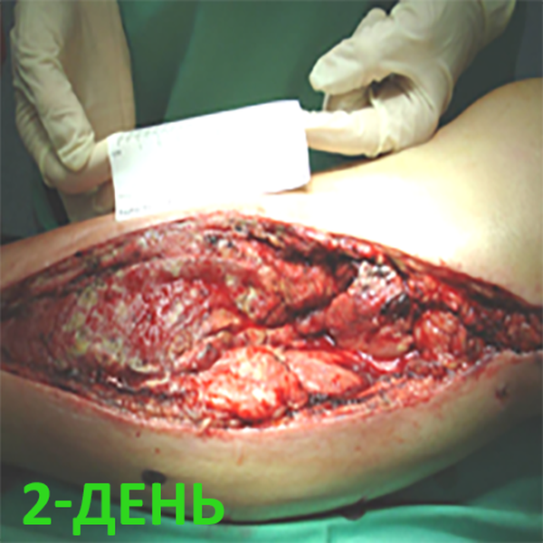 КЛИНИЧЕСКИЙ СЛУЧАЙ №3. ЗАЖИВЛЕНИЕ ВТОРИЧНЫМ НАТЯЖЕНИЕМ РАНА ПОСЛЕ АКШ image