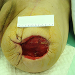 КЛИНИЧЕСКИЙ СЛУЧАЙ №1. ЭКЗАРТИКУЛЯЦИЯ С РЕВИЗИЕЙ КУЛЬТИ image