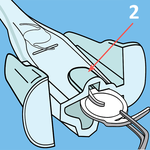 КАРТРИДЖИ ДЛЯ ВВЕДЕНИЯ ЛИНЗ image