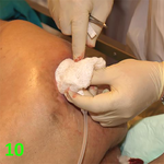 МЕТОДИКА НАЛОЖЕНИЯ ПОВЯЗКИ С ПРИМЕНЕНИЕМ СУПРАСОРБ CNP image