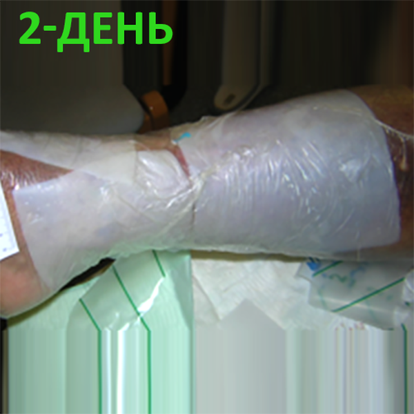 КЛИНИЧЕСКИЙ СЛУЧАЙ №3. ЯЗВА ГОЛЕНИ image