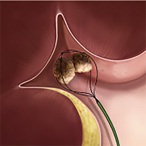 НИТИНОЛОВАЯ КОРЗИНА ДЛЯ ЛИТОЭКСТРАКЦИИ ZERO TIP image