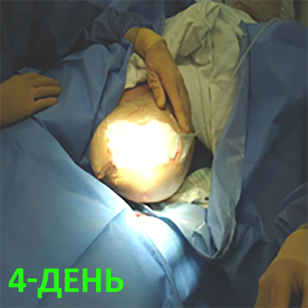 КЛИНИЧЕСКИЙ СЛУЧАЙ №1. ЭКЗАРТИКУЛЯЦИЯ С РЕВИЗИЕЙ КУЛЬТИ image