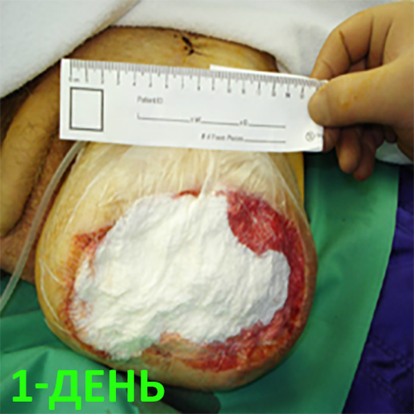 КЛИНИЧЕСКИЙ СЛУЧАЙ №1. ЭКЗАРТИКУЛЯЦИЯ С РЕВИЗИЕЙ КУЛЬТИ image