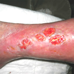 КЛИНИЧЕСКИЙ СЛУЧАЙ №2. ВЕНОЗНАЯ ЯЗВА image