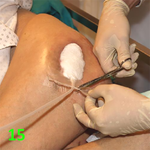 МЕТОДИКА НАЛОЖЕНИЯ ПОВЯЗКИ С ПРИМЕНЕНИЕМ СУПРАСОРБ CNP image