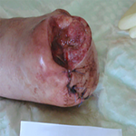 КЛИНИЧЕСКИЙ СЛУЧАЙ №2. ЗАЖИВЛЕНИЕ ВТОРИЧНЫМ НАТЯЖЕНИЕМ ПОСЛЕ АМПУТАЦИИ СТОПЫ image