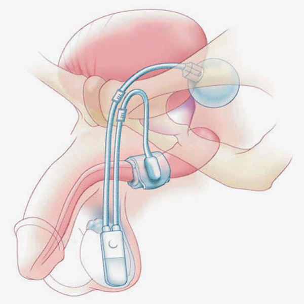ИСКУССТВЕННЫЙ СФИНКТЕР МОЧЕВОГО ПУЗЫРЯ AMS 800 image