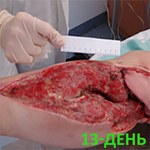 КЛИНИЧЕСКИЙ СЛУЧАЙ №3. ЗАЖИВЛЕНИЕ ВТОРИЧНЫМ НАТЯЖЕНИЕМ РАНА ПОСЛЕ АКШ image