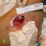 МЕТОДИКА НАЛОЖЕНИЯ ПОВЯЗКИ С ПРИМЕНЕНИЕМ СУПРАСОРБ CNP image