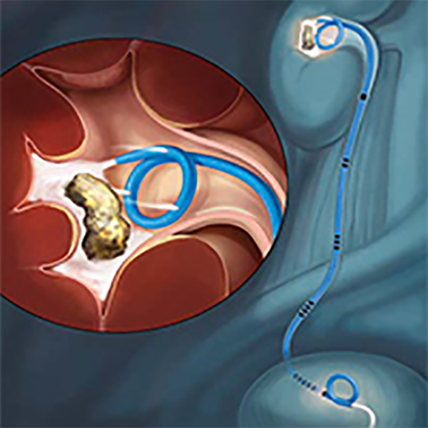 СТЕНТ МОЧЕТОЧНИКОВЫЙ УНИВЕРСАЛЬНОЙ ДЛИНЫ CONTOUR VL INJECTION image