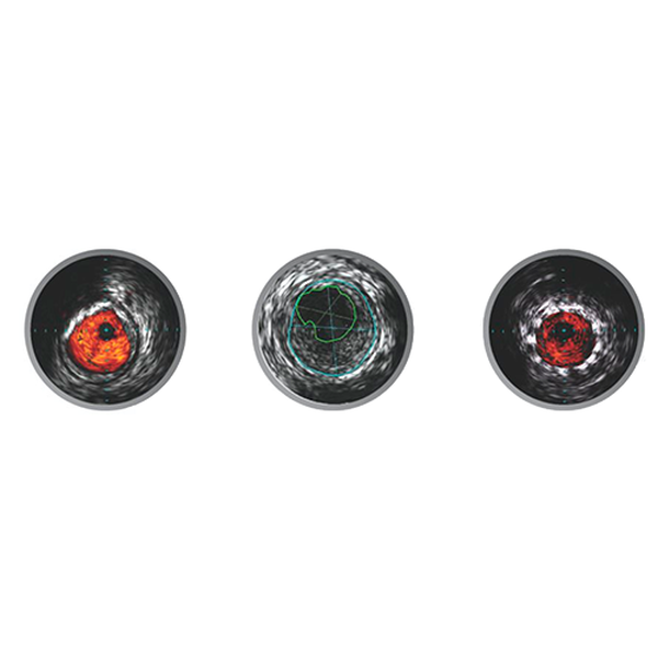 ЦИФРОВЫЕ КАТЕТЕРЫ ДЛЯ ПЕРИФЕРИЧЕСКИХ ВНУТРИСОСУДИСТЫХ УЛЬТРАЗВУКОВЫХ ИССЛЕДОВАНИЙ VISIONS image