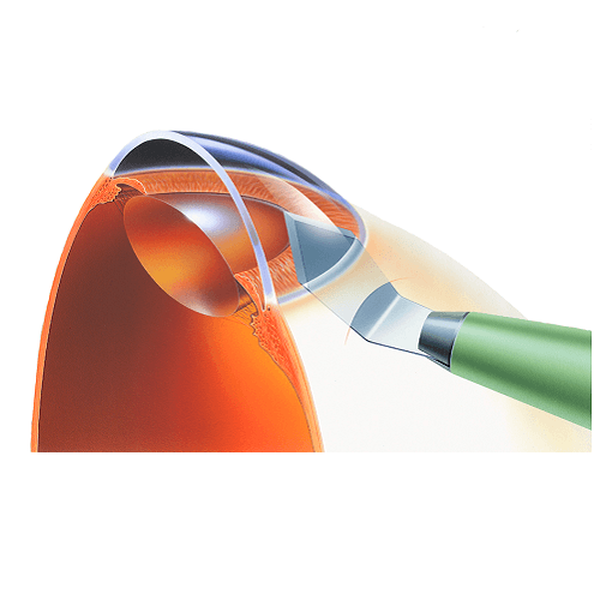 КЕРАТОМЫ ОФТАЛЬМОЛОГИЧЕСКИЕ СКАЛЬПЕЛИ image