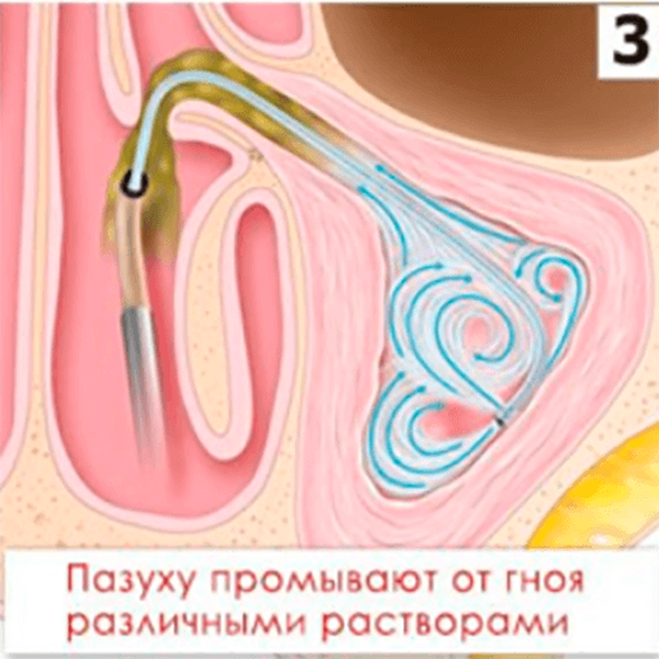 КАТЕТЕР ПРОВОДНИКОВЫЙ MESIRE image