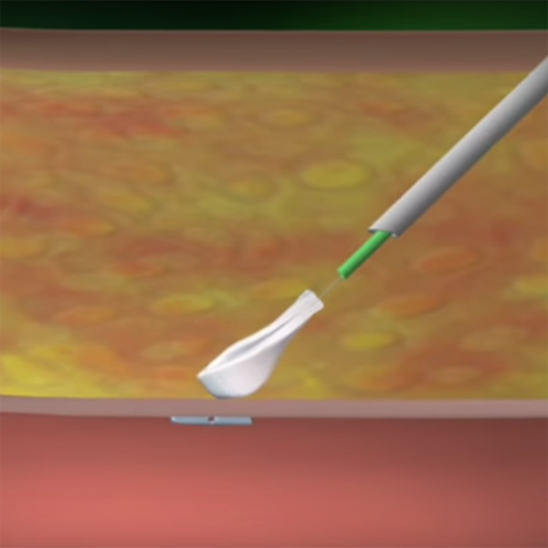 АНГИОСИЛ УСТРОЙСТВО ДЛЯ ЗАКРЫТИЯ ПУНКЦИИ (ANGIO-SEAL VIP) image