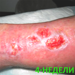 КЛИНИЧЕСКИЙ СЛУЧАЙ №2. ВЕНОЗНАЯ ЯЗВА image