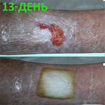 КЛИНИЧЕСКИЙ СЛУЧАЙ №4. ЯЗВА ГОЛЕНИ image