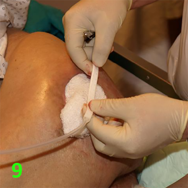 МЕТОДИКА НАЛОЖЕНИЯ ПОВЯЗКИ С ПРИМЕНЕНИЕМ СУПРАСОРБ CNP image