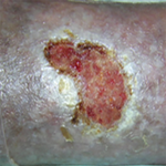 КЛИНИЧЕСКИЙ СЛУЧАЙ №4. ЯЗВА ГОЛЕНИ image