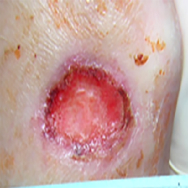 КЛИНИЧЕСКИЙ СЛУЧАЙ №5. ДИАБЕТИЧЕСКАЯ СТОПА image