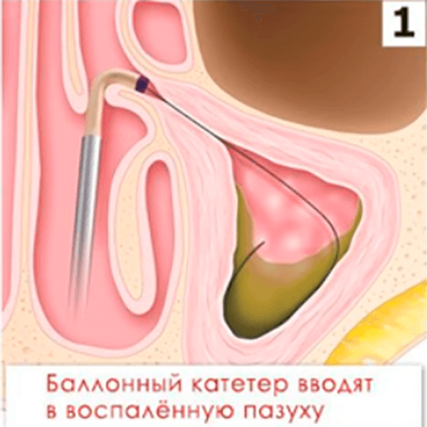 КАТЕТЕР ПРОВОДНИКОВЫЙ MESIRE image