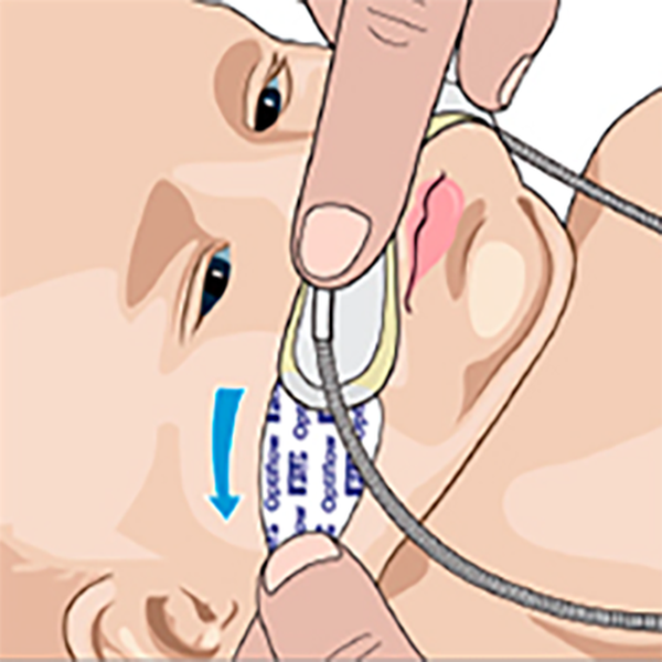 КАНЮЛИ OPTIFLOW ДЕТСКИЕ И НЕОНАТАЛЬНЫЕ image