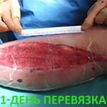 КЛИНИЧЕСКИЙ СЛУЧАЙ №3. ЗАЖИВЛЕНИЕ ВТОРИЧНЫМ НАТЯЖЕНИЕМ РАНА ПОСЛЕ АКШ image