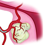 МИКРОСФЕРЫ ДЛЯ ЭМБОЛИЗАЦИИ EMBOSPHERE image