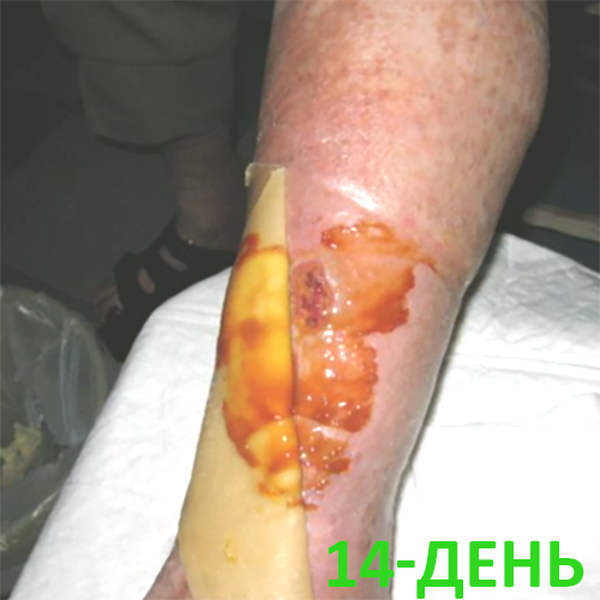 КЛИНИЧЕСКИЙ СЛУЧАЙ №2. ВЕНОЗНАЯ ЯЗВА image