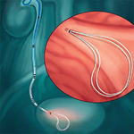 СТЕНТ МОЧЕТОЧНИКОВЫЙ POLARIS LOOP image