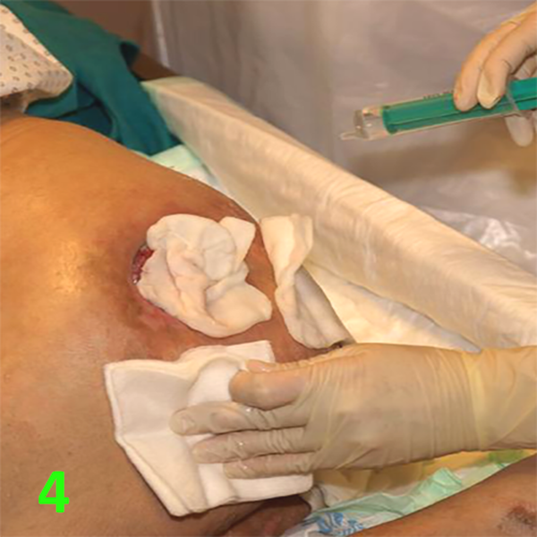 МЕТОДИКА НАЛОЖЕНИЯ ПОВЯЗКИ С ПРИМЕНЕНИЕМ СУПРАСОРБ CNP image