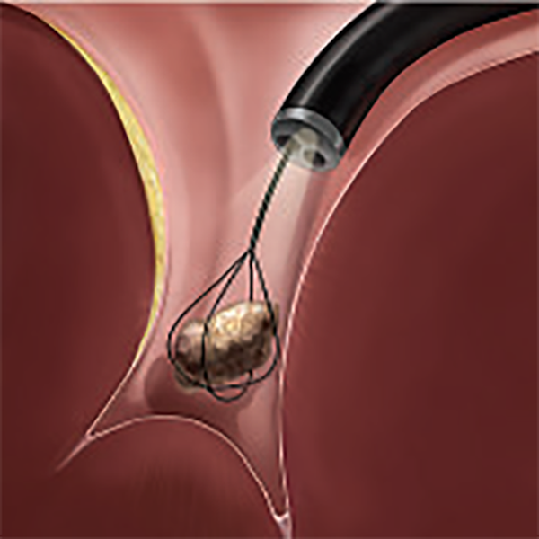 НИТИНОЛОВАЯ КОРЗИНА ДЛЯ ЛИТОЭКСТРАКЦИИ OPTIFLEX image