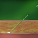 АНГИОСИЛ УСТРОЙСТВО ДЛЯ ЗАКРЫТИЯ ПУНКЦИИ (ANGIO-SEAL VIP) image