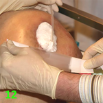 МЕТОДИКА НАЛОЖЕНИЯ ПОВЯЗКИ С ПРИМЕНЕНИЕМ СУПРАСОРБ CNP image