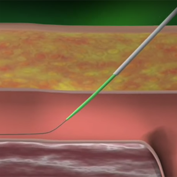 АНГИОСИЛ УСТРОЙСТВО ДЛЯ ЗАКРЫТИЯ ПУНКЦИИ (ANGIO-SEAL VIP) image