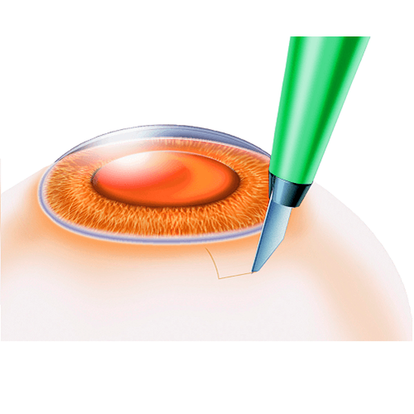 ГЛАУКОМНЫЙ СКАЛЬПЕЛЬ image