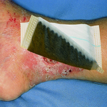 ФЛИВАКТИВ ПОВЯЗКА С АКТИВИРОВАННЫМ УГЛЕМ (VLIWACTIV) image