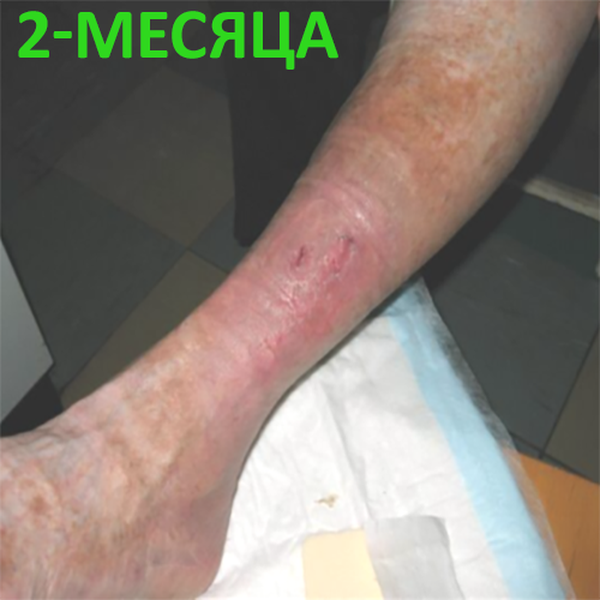 КЛИНИЧЕСКИЙ СЛУЧАЙ №2. ВЕНОЗНАЯ ЯЗВА image