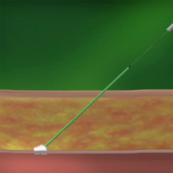 АНГИОСИЛ УСТРОЙСТВО ДЛЯ ЗАКРЫТИЯ ПУНКЦИИ (ANGIO-SEAL VIP) image