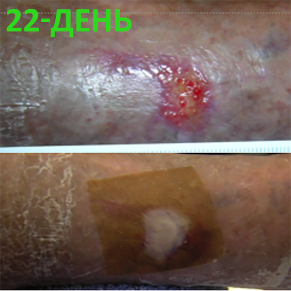 КЛИНИЧЕСКИЙ СЛУЧАЙ №4. ЯЗВА ГОЛЕНИ image