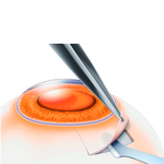 СКАЛЬПЕЛЬ-РАССЛАИВАТЕЛЬ В ФОРМЕ КЛЮШКИ image